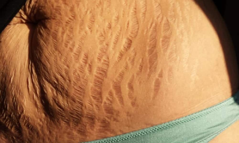 How to Prevent Stretch Marks and Cellulite with Simple Care